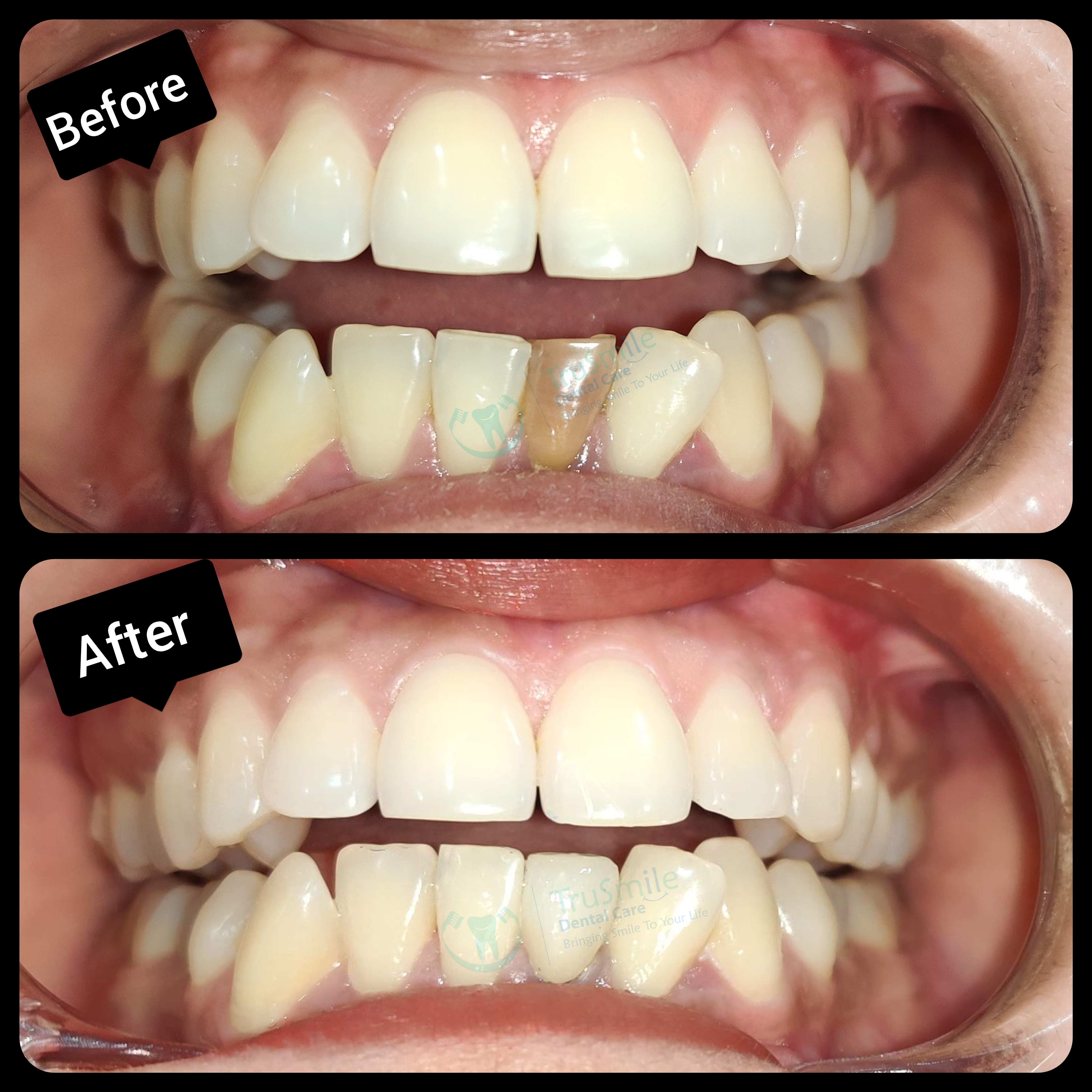 Zirconia 3